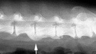 Spondylose